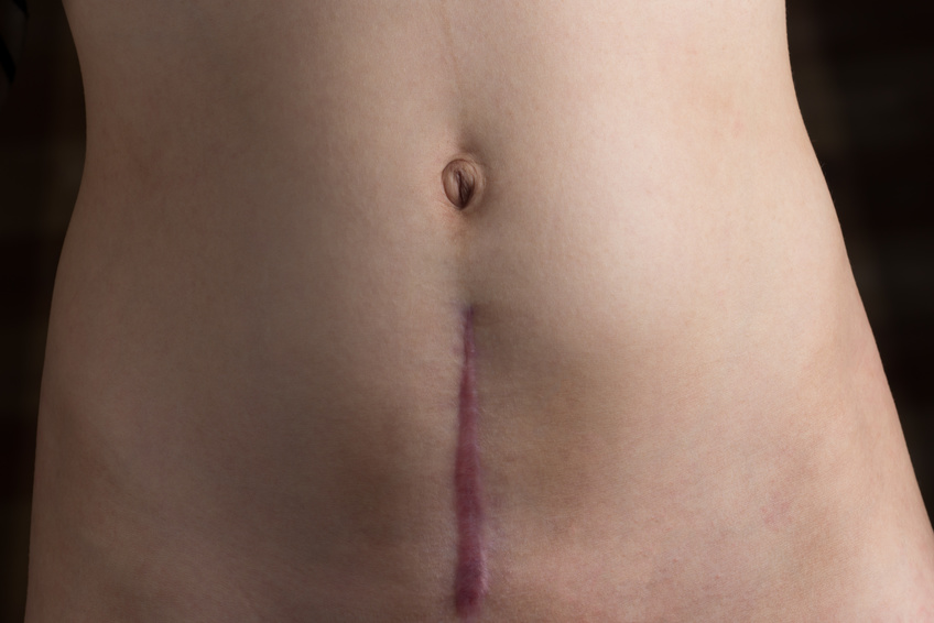 raised and discolored c-section scar